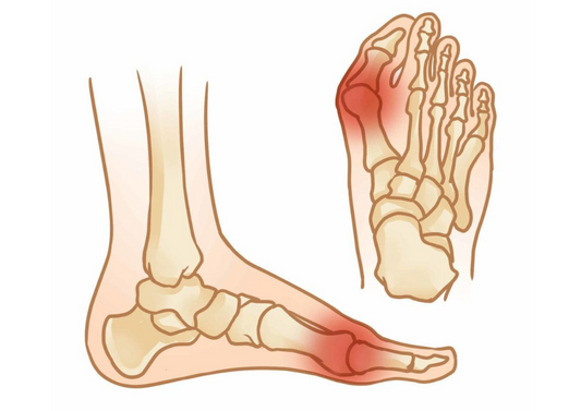 BUNIONS