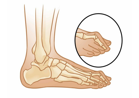 HAMMER TOES