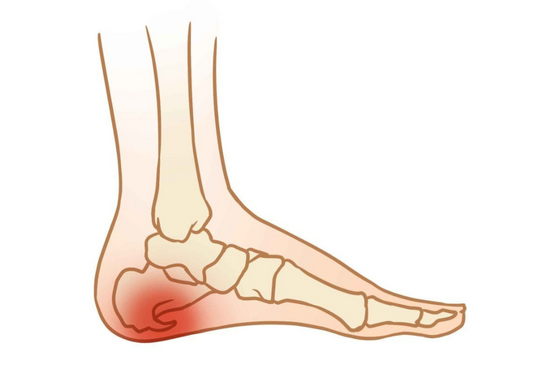 HEEL SPUR