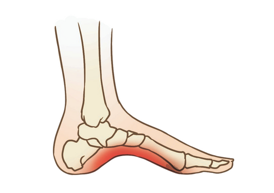 HIGH ARCH FEET