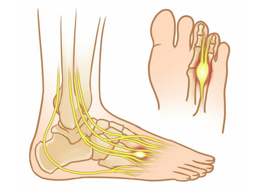 MORTON’S NEUROMA