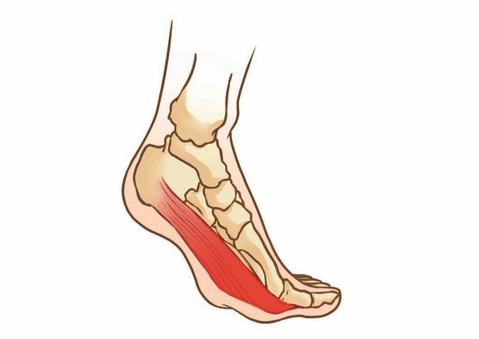 PLANTAR FASCIITIS