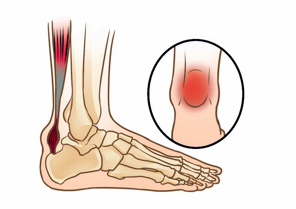 ACHILLES TENDONITIS – BODYFEET