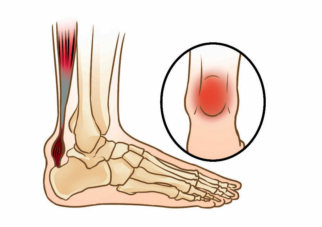 ACHILLES TENDONITIS – BODYFEET